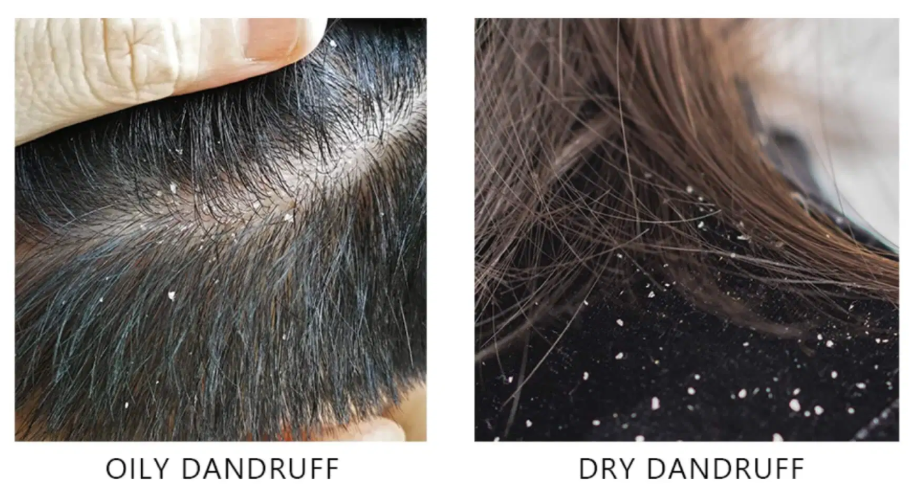 OILY Dandruff vs DRY Dandruff : Learn the Causes & Differences